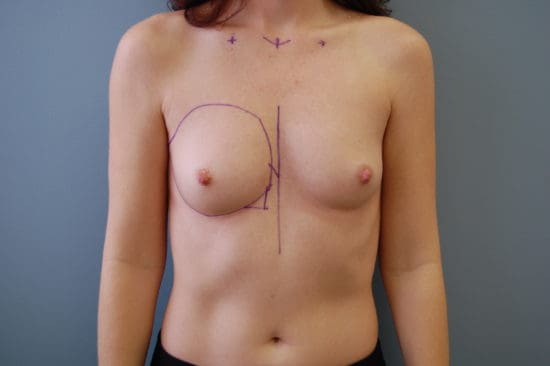 Transaxillary Subpectoral Augmentation Before and After Pictures Columbia, SC