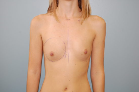 Transaxillary Subpectoral Augmentation Before and After Pictures Columbia, SC