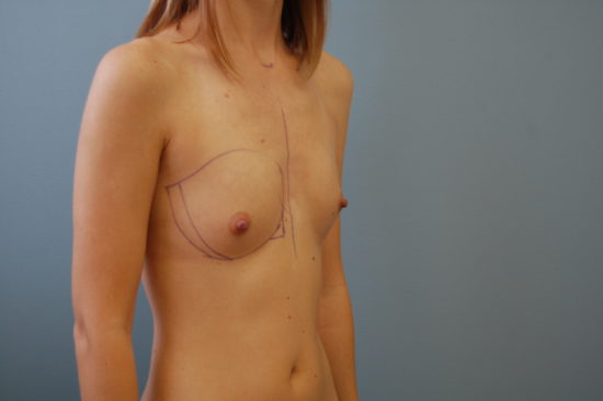Transaxillary Subpectoral Augmentation Before and After Pictures Columbia, SC