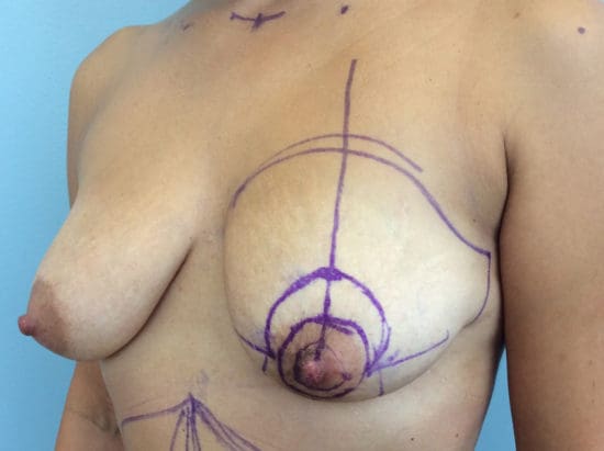 Breast Lift with Augmentation Before and After Pictures Columbia, SC