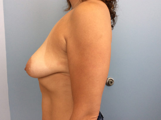 Breast Lift with Augmentation Before and After Pictures Columbia, SC
