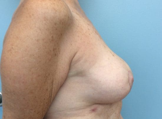 Complex Breast Surgery Before and After Pictures Columbia, SC