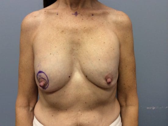 Complex Breast Surgery Before and After Pictures Columbia, SC