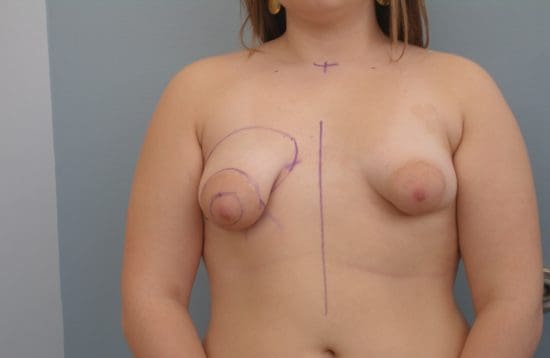 Complex Breast Surgery Before and After Pictures Columbia, SC