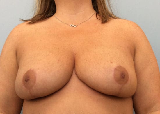 Breast Reduction Before and After Pictures Columbia, SC