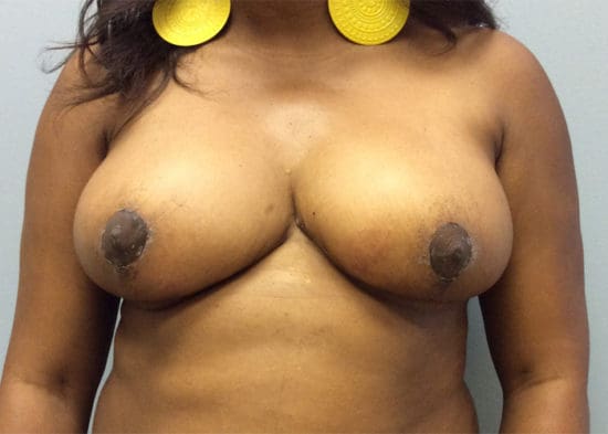 Breast Reduction Before and After Pictures Columbia, SC