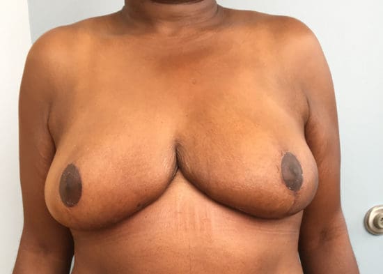 Breast Reduction Before and After Pictures Columbia, SC