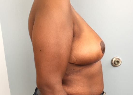 Breast Reduction Before and After Pictures Columbia, SC