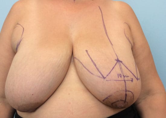 Breast Reduction Before and After Pictures Columbia, SC