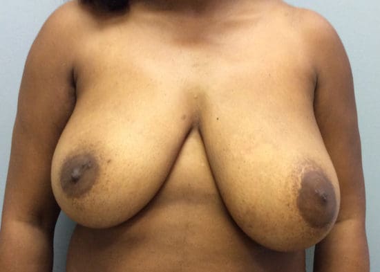 Breast Reduction Before and After Pictures Columbia, SC