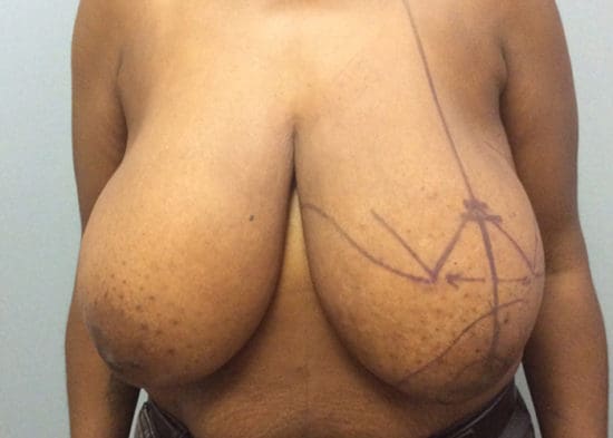 Breast Reduction Before and After Pictures Columbia, SC