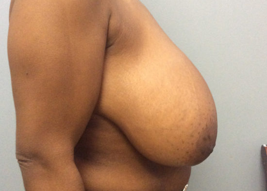 Breast Reduction Before and After Pictures Columbia, SC