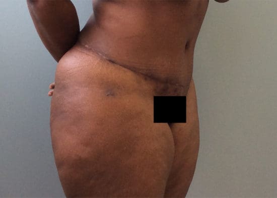 Tummy Tuck (Anterior Torsoplasty) Before and After Pictures Columbia, SC