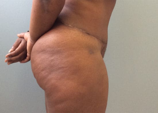 Tummy Tuck (Anterior Torsoplasty) Before and After Pictures Columbia, SC