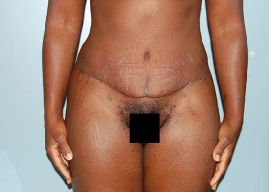 Tummy Tuck (Anterior Torsoplasty) Before and After Pictures Columbia, SC