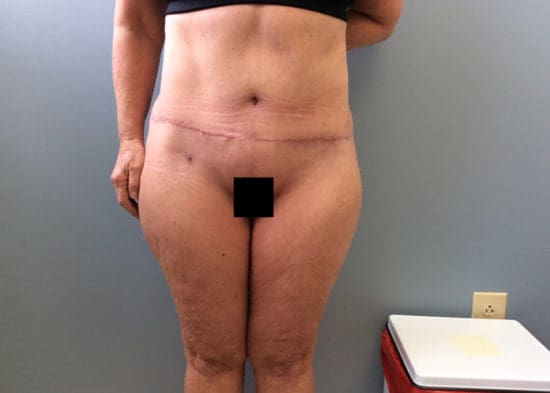 Tummy Tuck (Anterior Torsoplasty) Before and After Pictures Columbia, SC