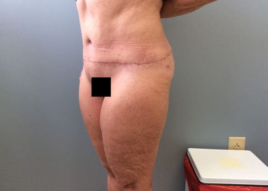 Tummy Tuck (Anterior Torsoplasty) Before and After Pictures Columbia, SC