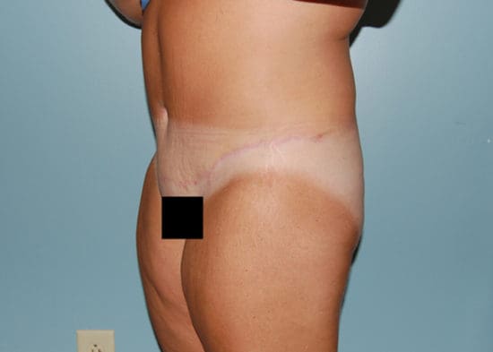 Tummy Tuck (Anterior Torsoplasty) Before and After Pictures Columbia, SC