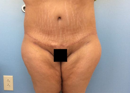 Tummy Tuck (Anterior Torsoplasty) Before and After Pictures Columbia, SC