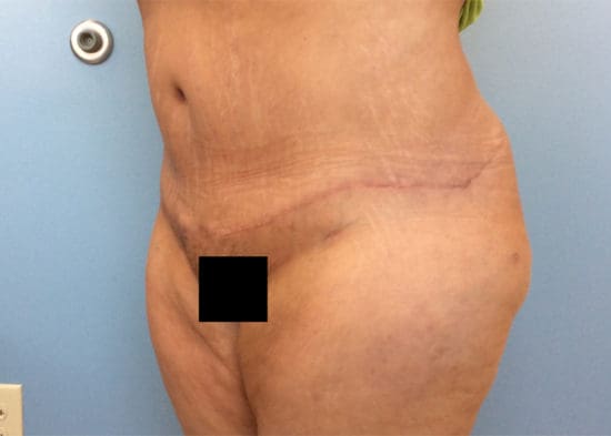 Tummy Tuck (Anterior Torsoplasty) Before and After Pictures Columbia, SC