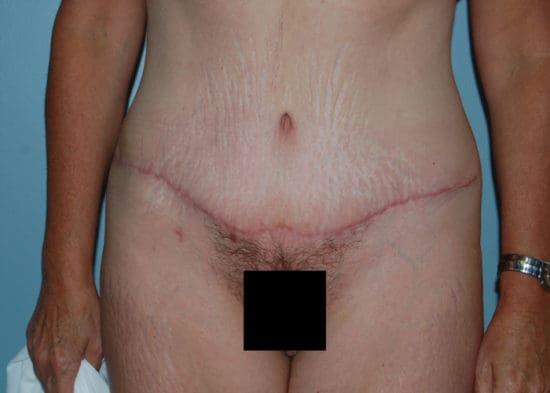 Tummy Tuck (Anterior Torsoplasty) Before and After Pictures Columbia, SC