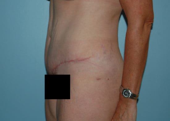 Tummy Tuck (Anterior Torsoplasty) Before and After Pictures Columbia, SC