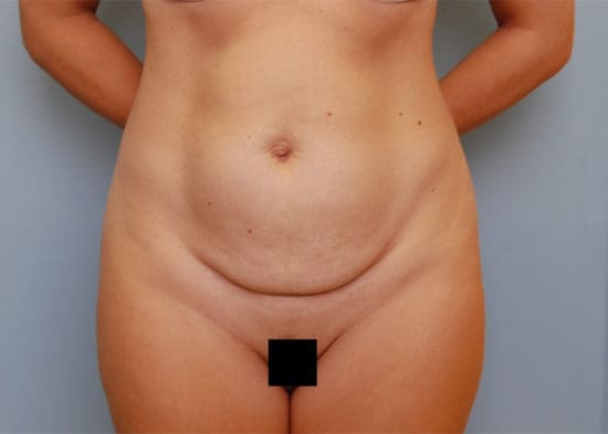 Tummy Tuck (Anterior Torsoplasty) Before and After Pictures Columbia, SC