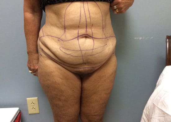 Tummy Tuck (Anterior Torsoplasty) Before and After Pictures Columbia, SC