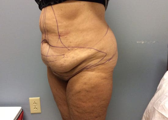 Tummy Tuck (Anterior Torsoplasty) Before and After Pictures Columbia, SC