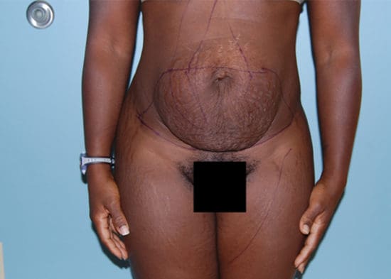 Tummy Tuck (Anterior Torsoplasty) Before and After Pictures Columbia, SC