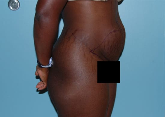 Tummy Tuck (Anterior Torsoplasty) Before and After Pictures Columbia, SC