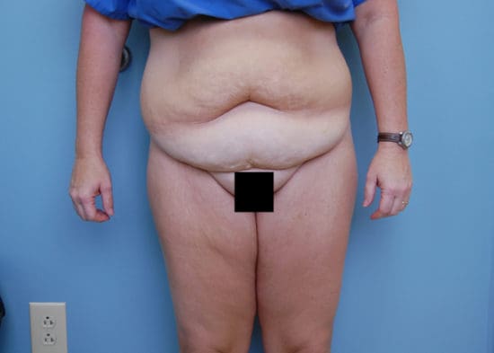 Tummy Tuck (Anterior Torsoplasty) Before and After Pictures Columbia, SC
