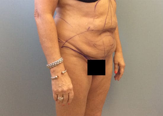 Tummy Tuck (Anterior Torsoplasty) Before and After Pictures Columbia, SC