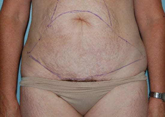 Tummy Tuck (Anterior Torsoplasty) Before and After Pictures Columbia, SC