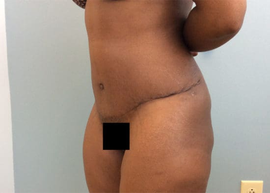 Tummy Tuck (Anterior Torsoplasty) Before and After Pictures Columbia, SC