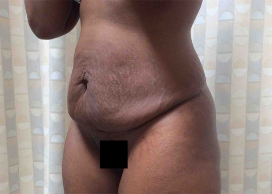 Tummy Tuck (Anterior Torsoplasty) Before and After Pictures Columbia, SC