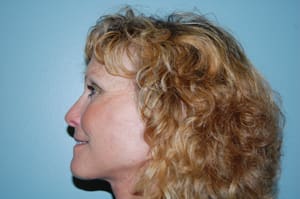 Facelift Before and After Pictures Columbia, SC