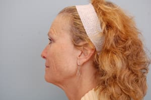 Facelift Before and After Pictures Columbia, SC