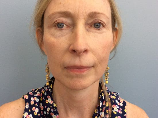 Facelift Before and After Pictures Columbia, SC