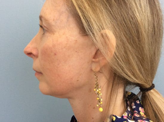 Facelift Before and After Pictures Columbia, SC