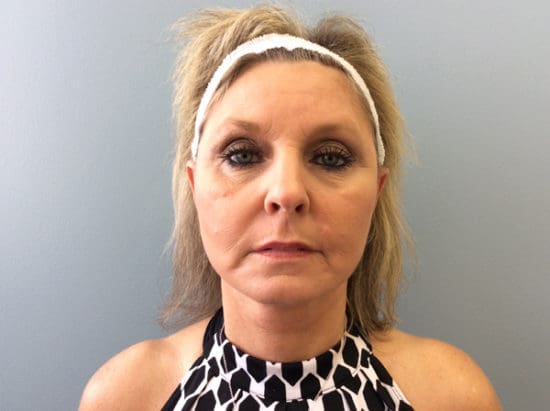 Facelift Before and After Pictures Columbia, SC