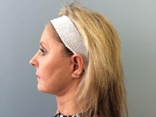 Facelift Before and After Pictures Columbia, SC