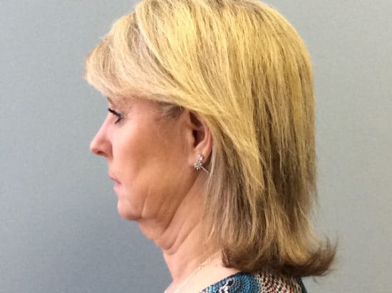 Facelift Before and After Pictures Columbia, SC