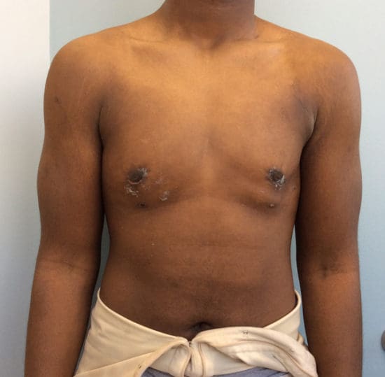 Gynecomastia Before and After Pictures Columbia, SC