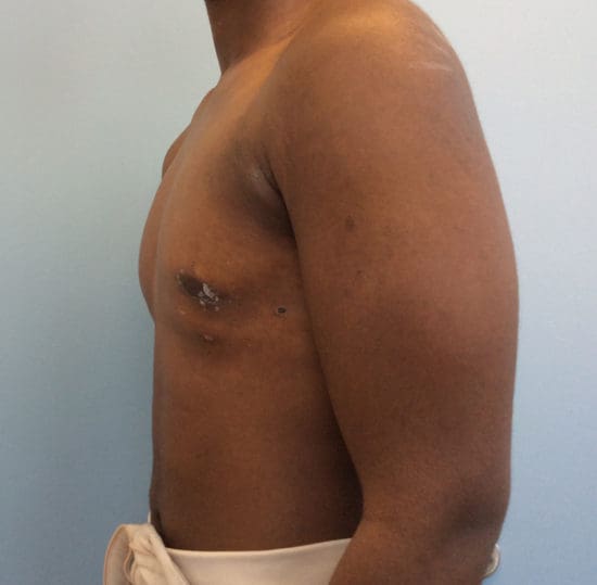 Gynecomastia Before and After Pictures Columbia, SC