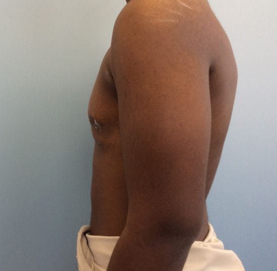 Gynecomastia Before and After Pictures Columbia, SC