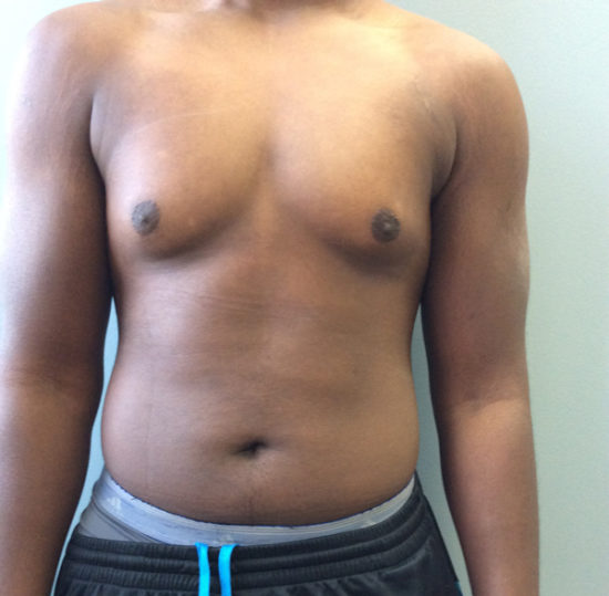 Gynecomastia Before and After Pictures Columbia, SC