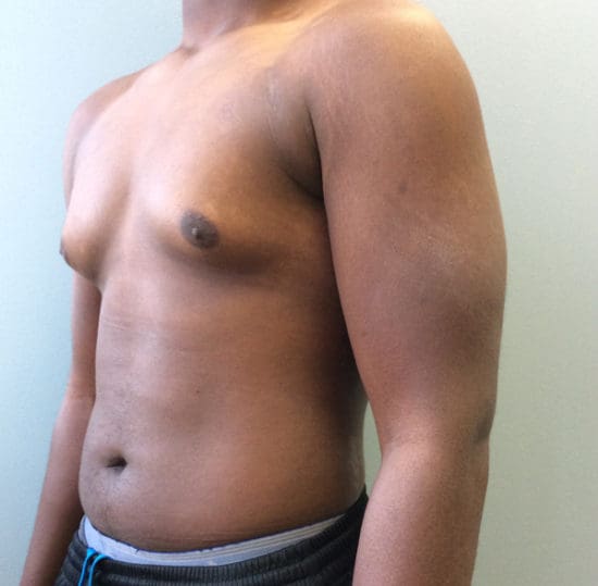 Gynecomastia Before and After Pictures Columbia, SC