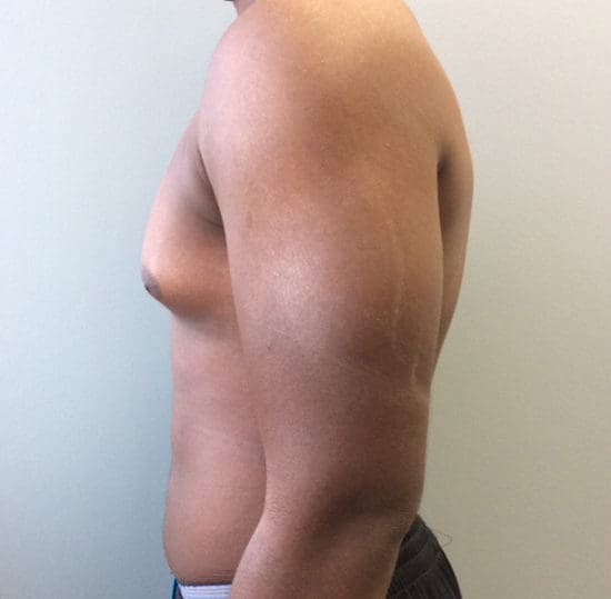 Gynecomastia Before and After Pictures Columbia, SC