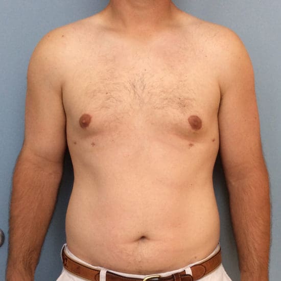 Gynecomastia Before and After Pictures Columbia, SC